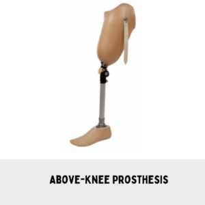 Above-Knee Prosthesis